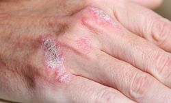 Kışın soğuk ve kuru hava cilt sorunlarını artırıyor