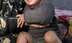 Teröristler 1 yaşındaki bebeğin bacağında sigara söndürdü