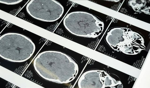 Uzmanlardan masajla gelen inme uyarısı