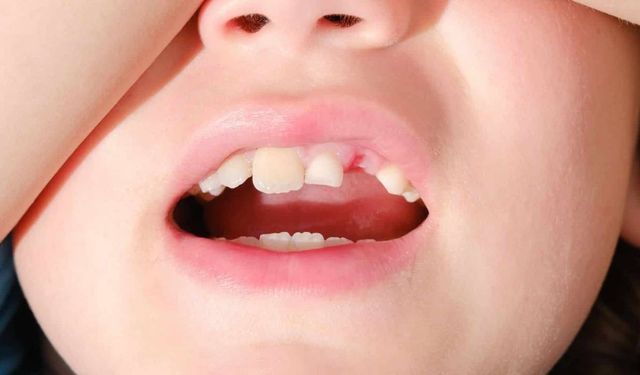 Bakanlık'tan 'dental travma' rehberi: İlk 60 dakika çok önemli