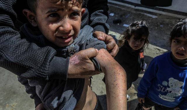 Gazze'de 'salgın hastalık' alarmı!