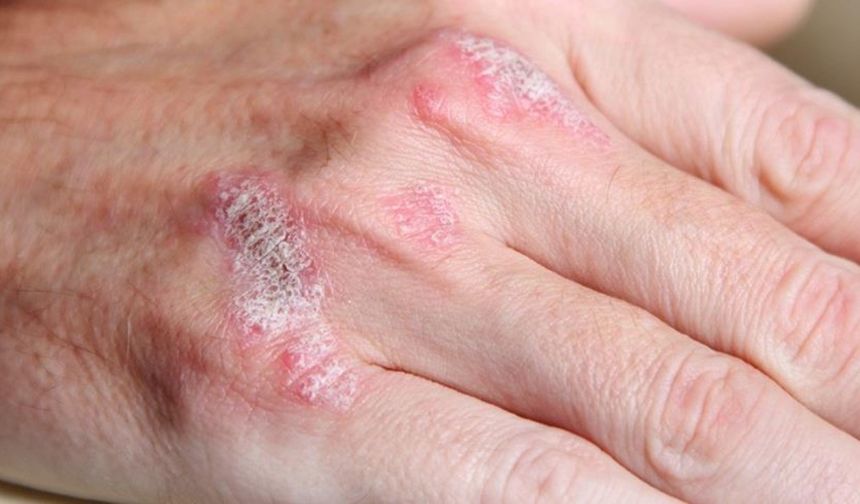 Kışın soğuk ve kuru hava cilt sorunlarını artırıyor