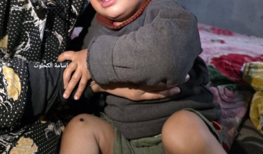 Teröristler 1 yaşındaki bebeğin bacağında sigara söndürdü